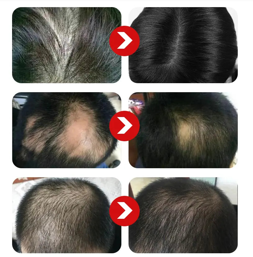 FEG  Treatment Growth Hair Reduce Loss Hair Growth Spray Water Base Natural Hair Growth